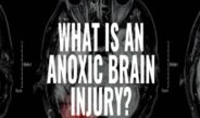 Causes and Treatment Anoxic Brain Injury