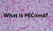 Pecoma Tumors Symptoms,Treatment And Advice