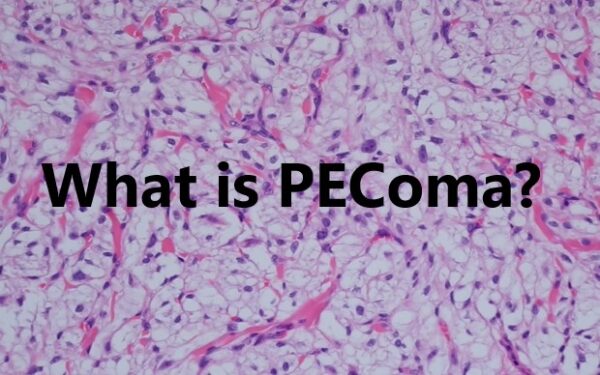 Pecoma Tumors Symptoms,Treatment And Advice