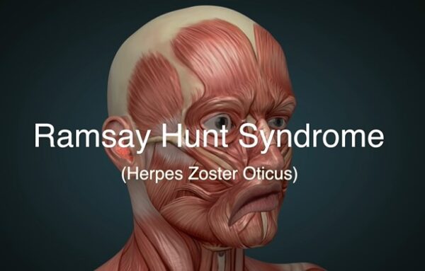 Ramsay Hunt Syndrome Recovery and Treatment Process