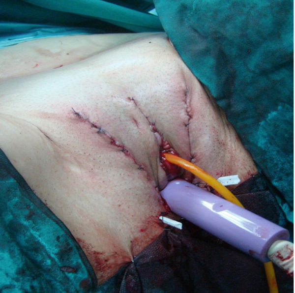 mtf bottom surgery results and before after pictures