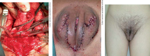 mtf bottom surgery results and before after pictures